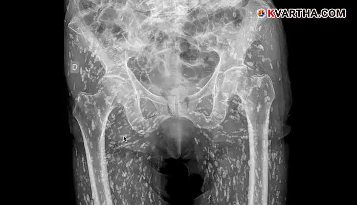 X-ray showing hundreds of tapeworm cysts in a man's body due to cysticercosis.