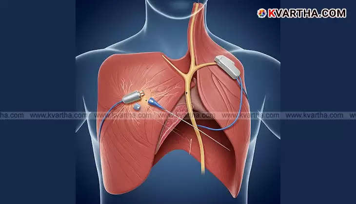  Phrenic Nerve Pacing Medical Treatment for Respiratory Issues