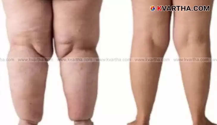 Lipedema: A Threat to Indian Women's Health